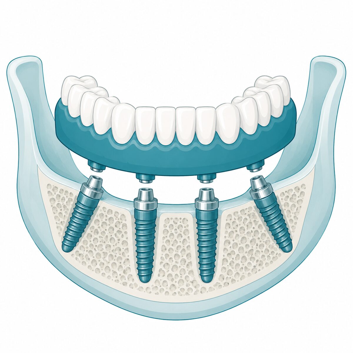 All-on-4 Dental Implants Explained: Full Smile in One Day