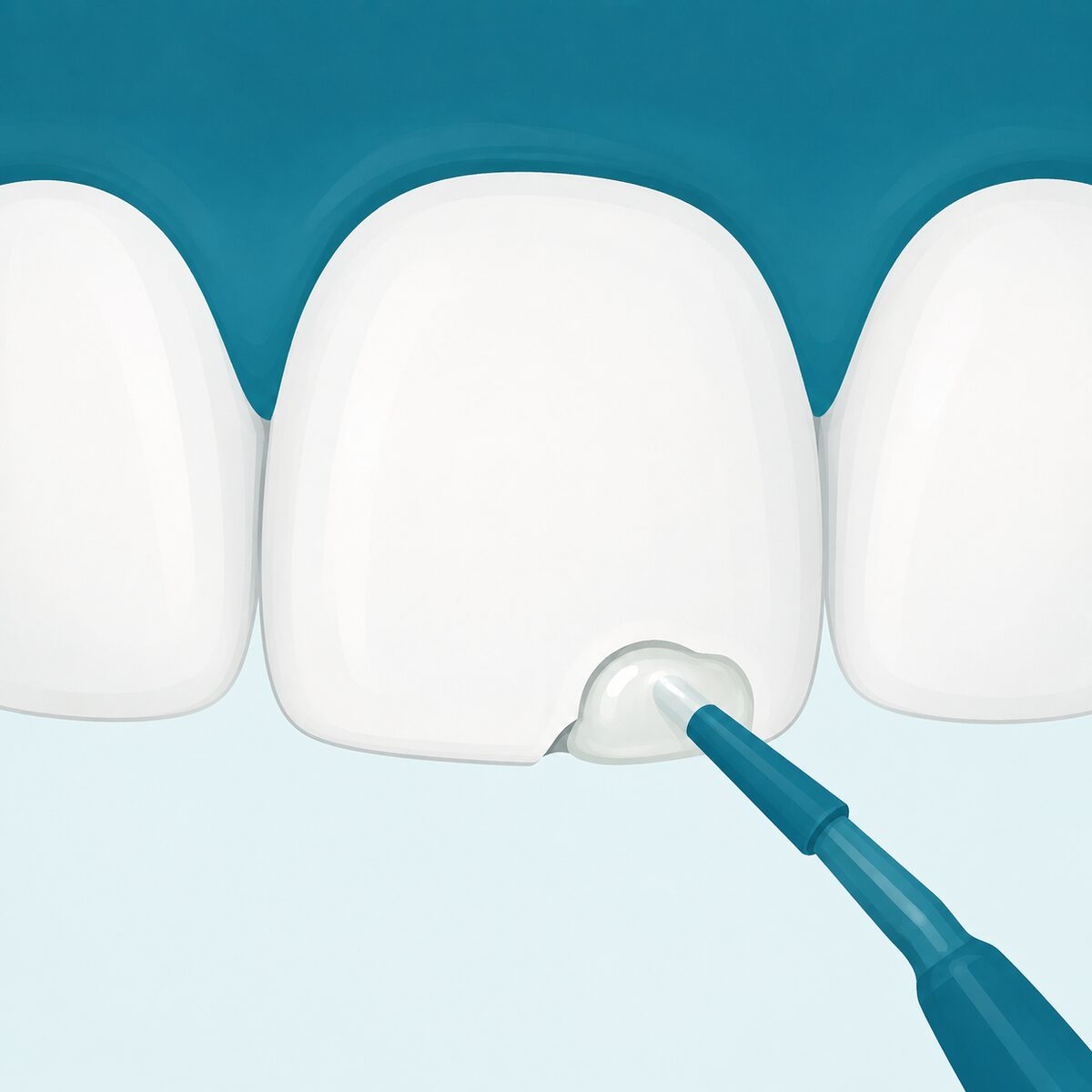 Chipped or Cracked Tooth: What to Do in the First 24 Hours