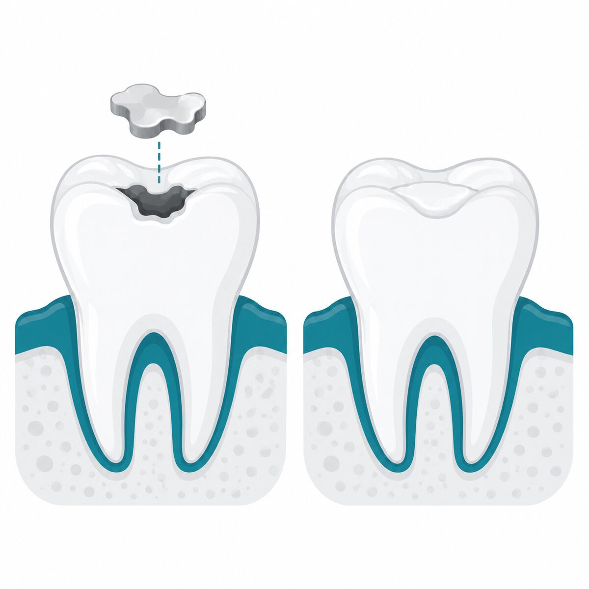 Why Do Fillings Fall Out & How to Make Them Last