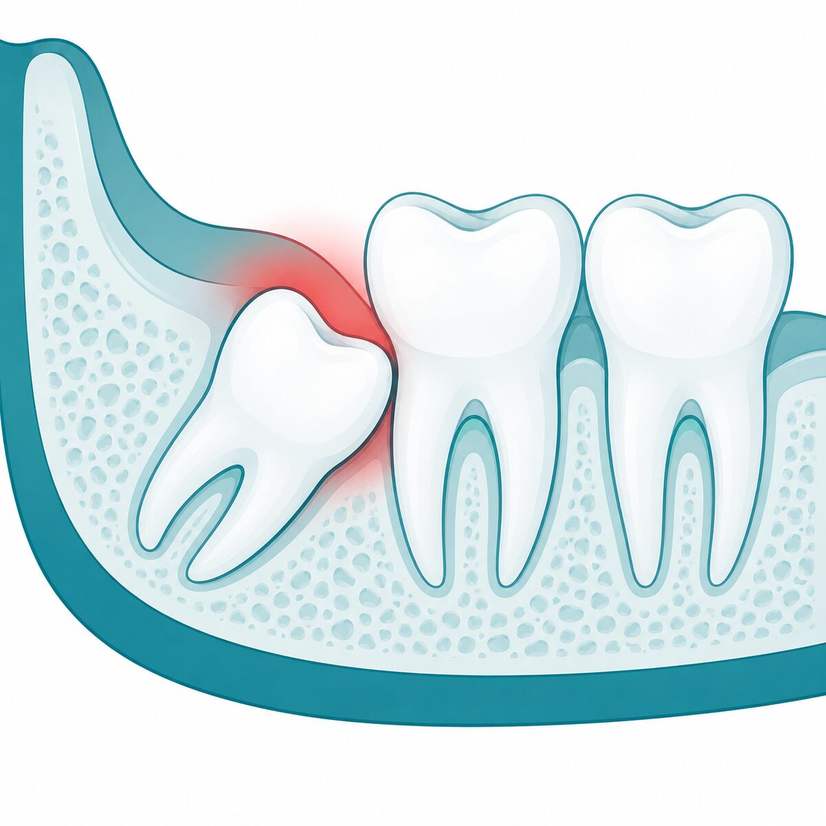 Wisdom Tooth Pain: Home Relief vs When to Remove It
