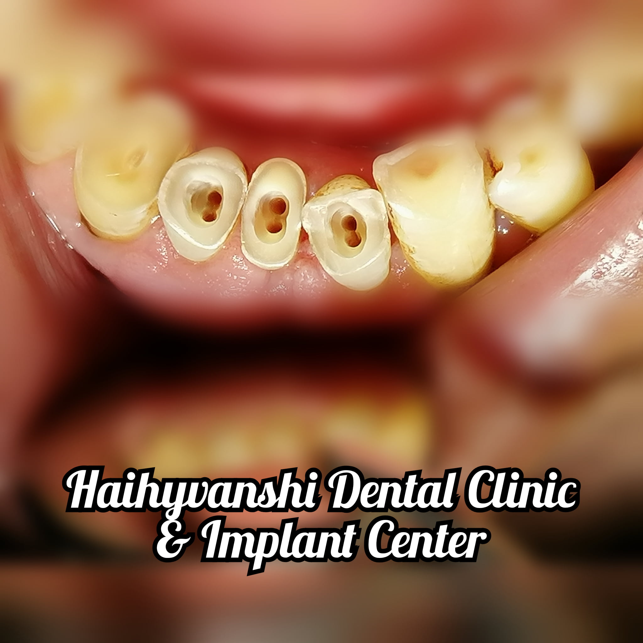 Smile Transformation