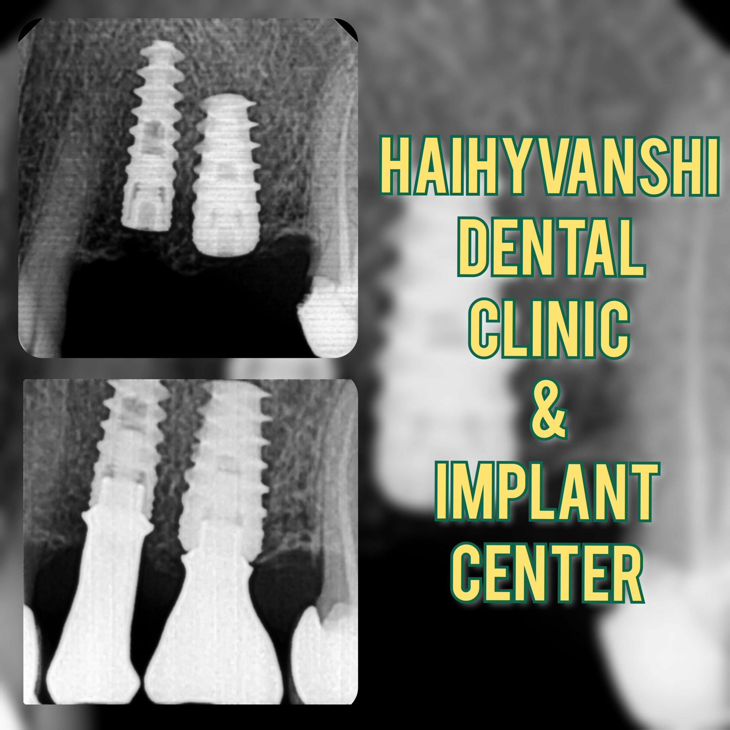 Before & After X-Ray