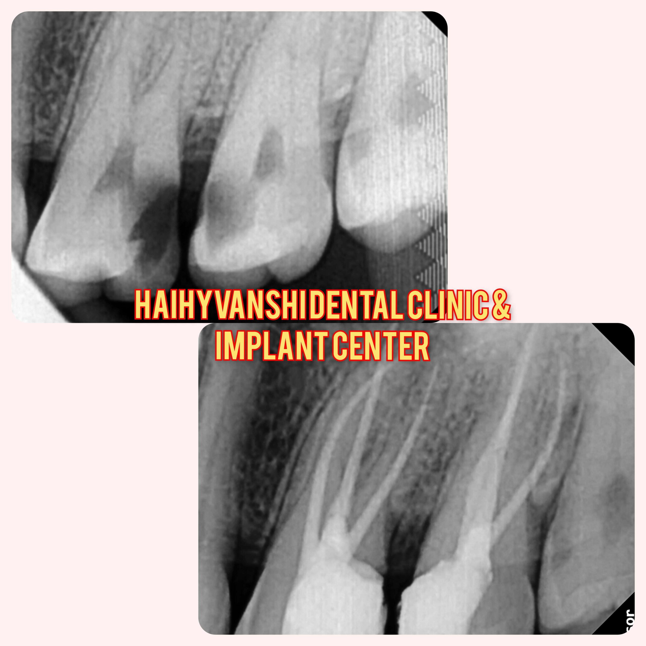 Root Canal Case